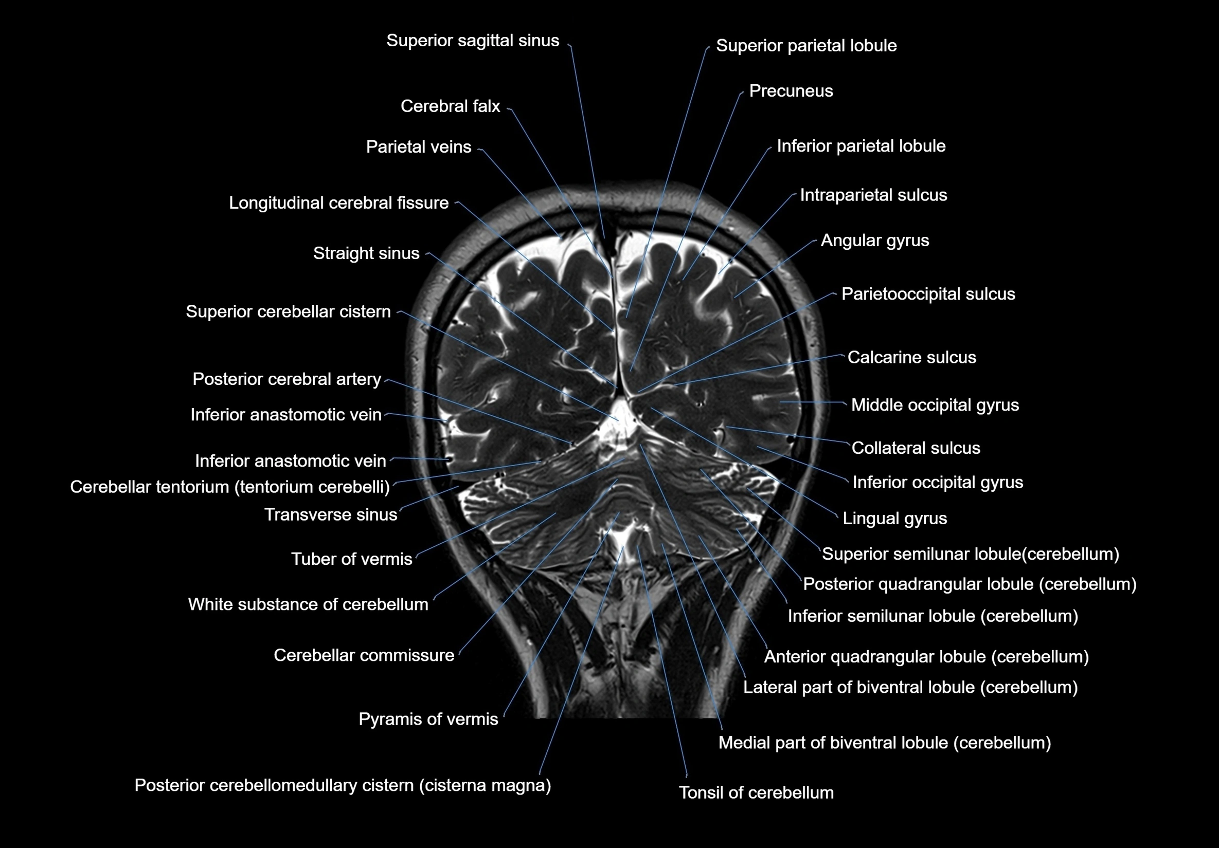 MRI Brain coronal cross sectional labelled anatomy 3T image  -img-00001-00058.webp